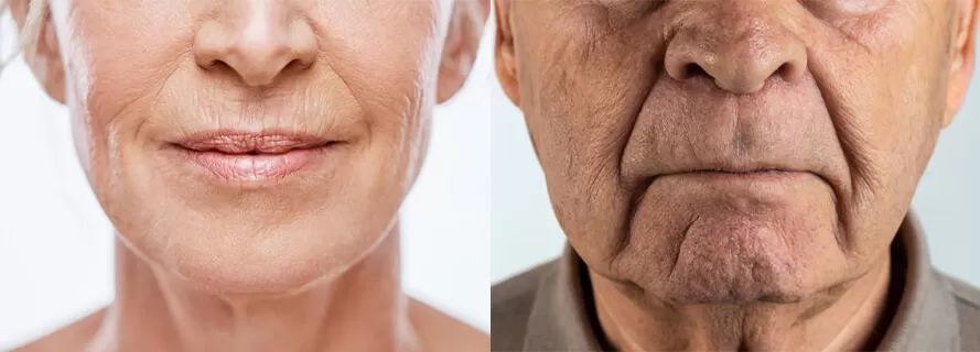 افزایش فاصله لب ها تا بینی در پیری